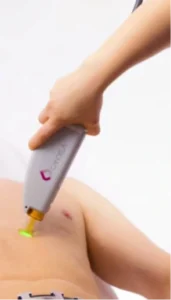 Haarentfernung Startseite Angie Lux